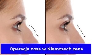 Operacja nosa w Niemczech cena